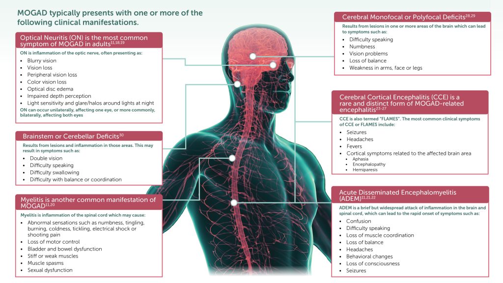 Clinical Manifestations MOGAD typically presents with one or more of the following clinical manifestations. Optic neuritis (ON) is the most common symptom of MOGAD in adults. ON is inflammation of the optic nerve, often presenting as: • Blurry vision • Vision loss • Peripheral vision loss • Color vision loss • Optical disc edema • Impaired depth perception • Light sensitivity and glare/halos around lights at night ON can occur unilaterally, affecting one eye, or more commonly, bilaterally, affecting both eyes. Brainstem or cerebellar deficits result from lesions and inflammation in those areas. This may result in symptoms such as: • Double vision • Difficulty speaking • Difficulty swallowing • Difficulty with balance or coordination Myelitis, another common manifestation of MOGAD, is inflammation of the spinal cord which may cause: • Abnormal sensations such as numbness, tingling, burning, coldness, tickling, electrical shock or shooting pain • Loss of motor control • Bladder and bowel dysfunction • Stiff or weak muscles • Muscle spasms • Sexual dysfunction Cerebral monofocal or polyfocal deficits result from lesions in one or more areas of the brain which can lead to symptoms such as: • Difficulty speaking • Numbness • Vision problems • Loss of balance • Weakness in arms, face or legs Cerebral cortical encephalitis (CCE) is a rare and distinct form of MOGAD-related encephalitis. CCE is also termed “FLAMES”. The most common clinical symptoms of CCE or FLAMES include: • Seizures • Headaches • Fevers • Cortical symptoms related to the affected brain area o Aphasia o Encephalopathy o Hemiparesis Acute disseminated encephalomyelitis (ADEM) is a brief but widespread attack of inflammation in the brain and spinal cord, which can lead to the rapid onset of symptoms such as: • Confusion • Difficulty speaking • Loss of muscle coordination • Loss of balance • Headaches • Behavioral changes • Loss of consciousness • Seizures